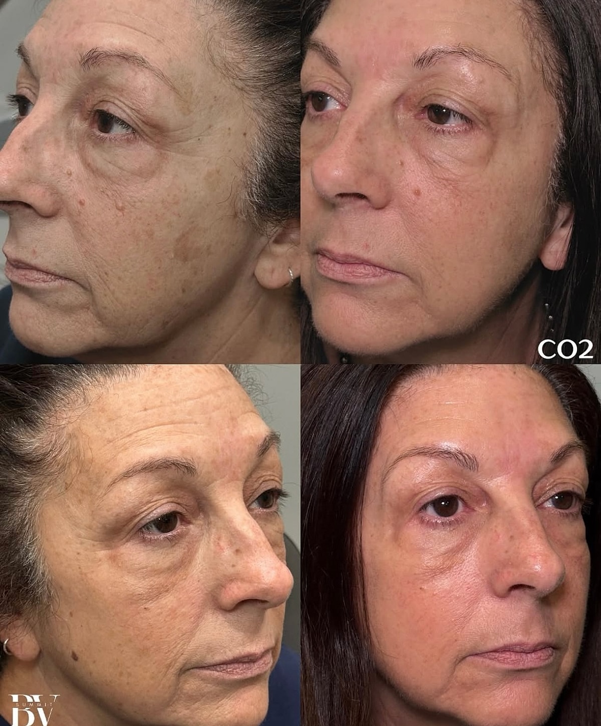 Before and after skincare treatment results.