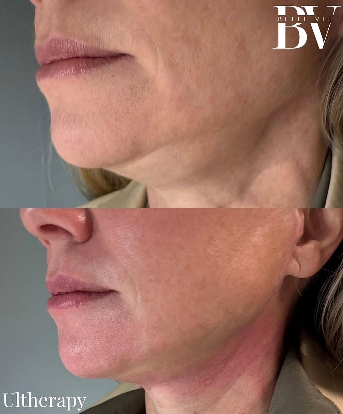 Ultherapy before and after treatment comparison.