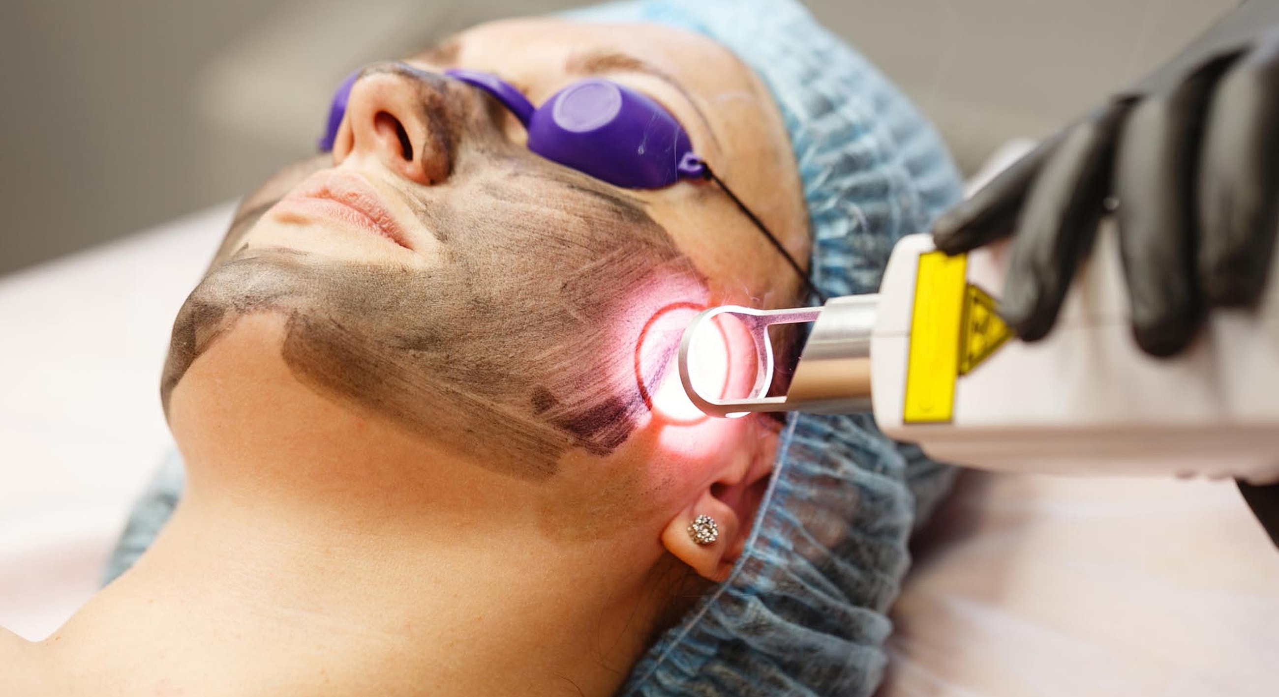 Facial treatment using laser equipment and mask.