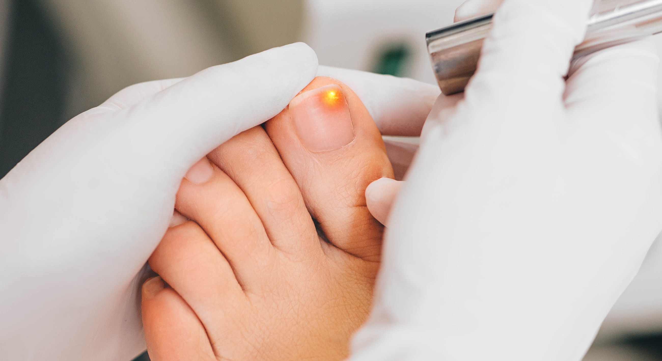 Laser treatment on a toe nail.
