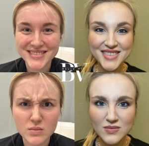 Botox Lexington Ky Before and After